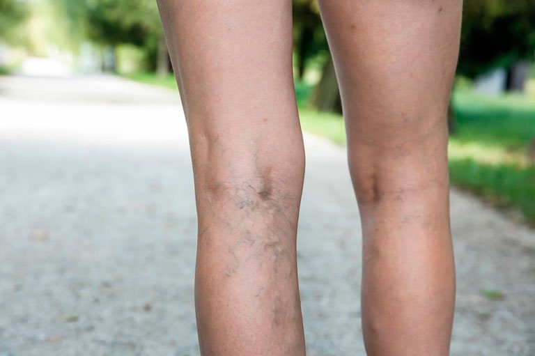 Beine mit ausgeprägten Krampfadern